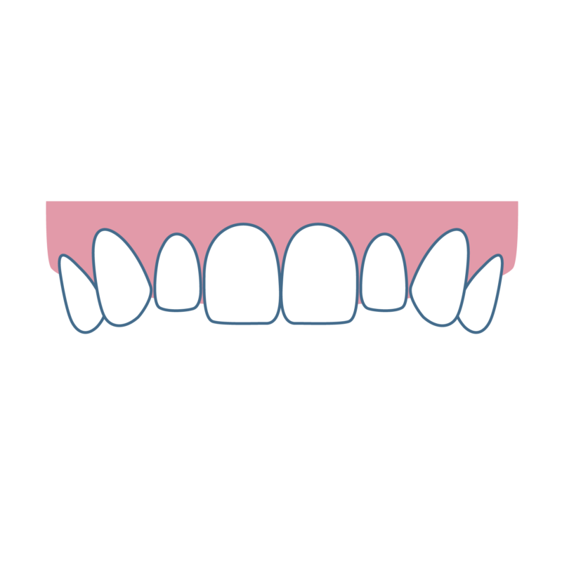 矮小歯