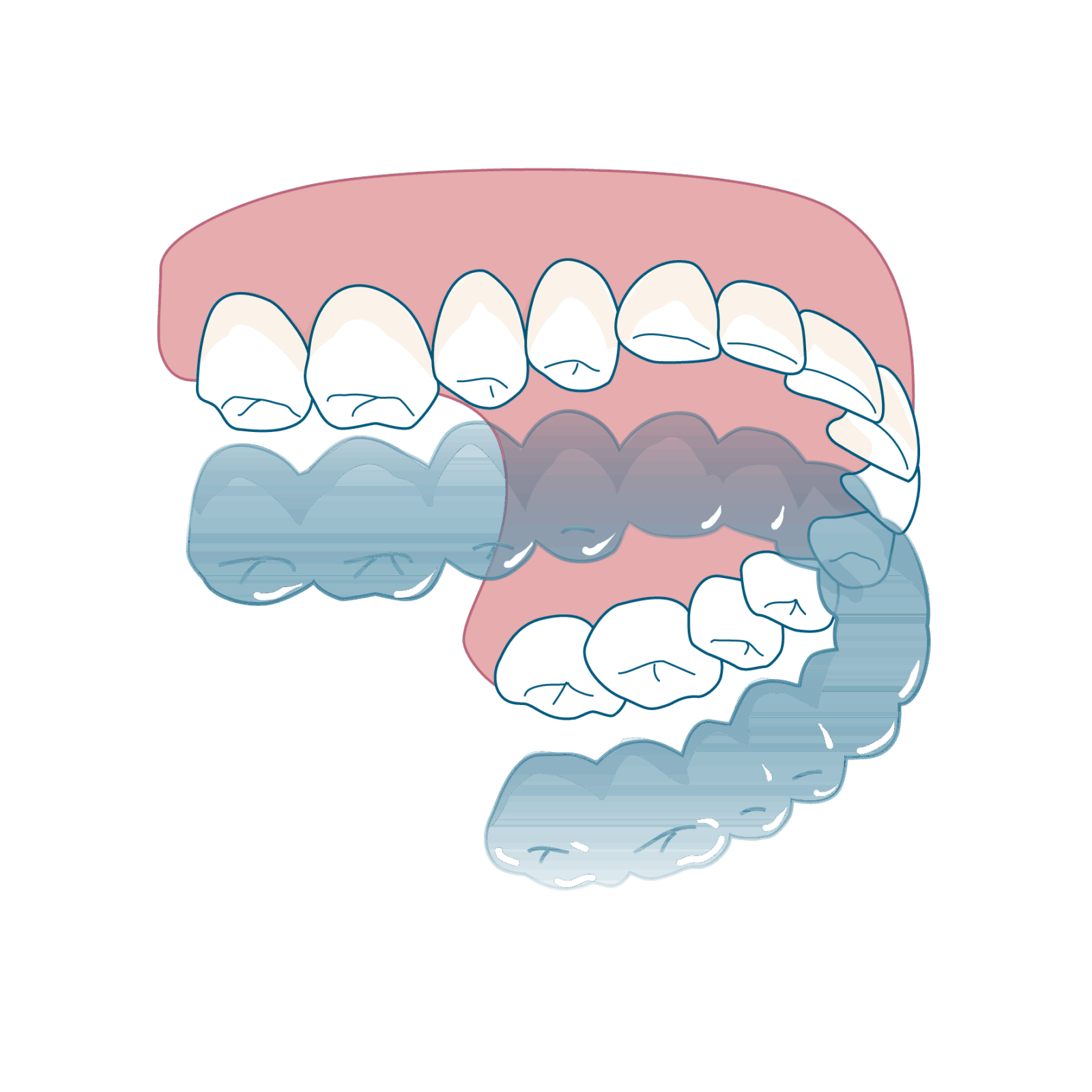 マウスピース矯正