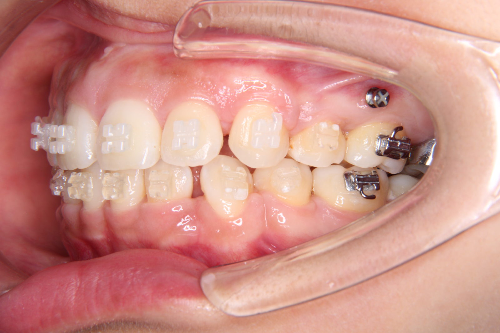 実際に口腔内に装着したアンカースクリュー