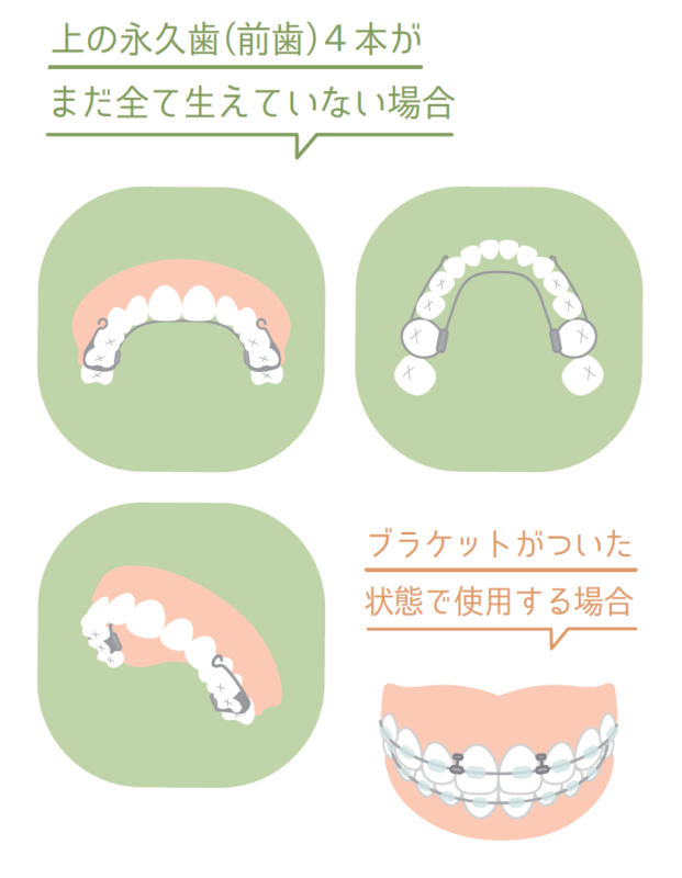 リンガルアーチ・マルチブラケット装置