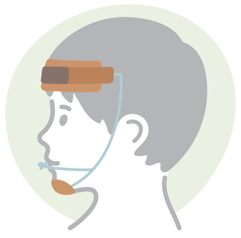 上顎前方牽引装置