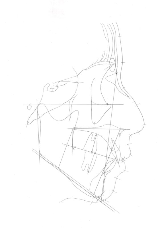 側方セファロトレース