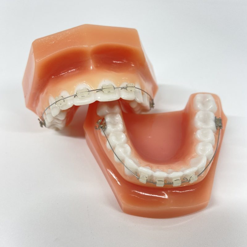 子どものワイヤー矯正