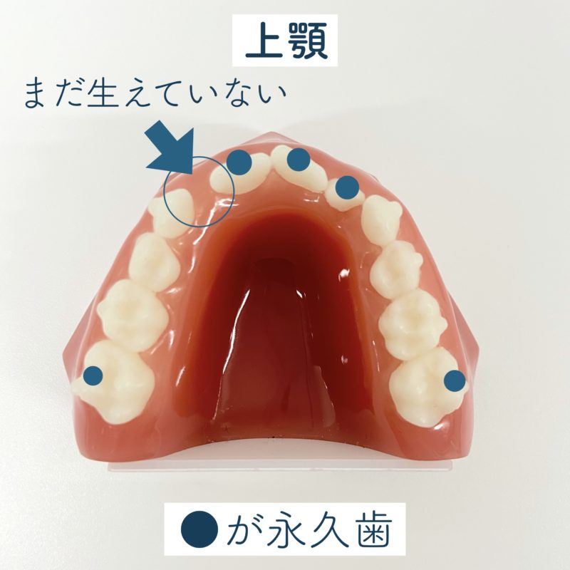 上顎・混合歯列