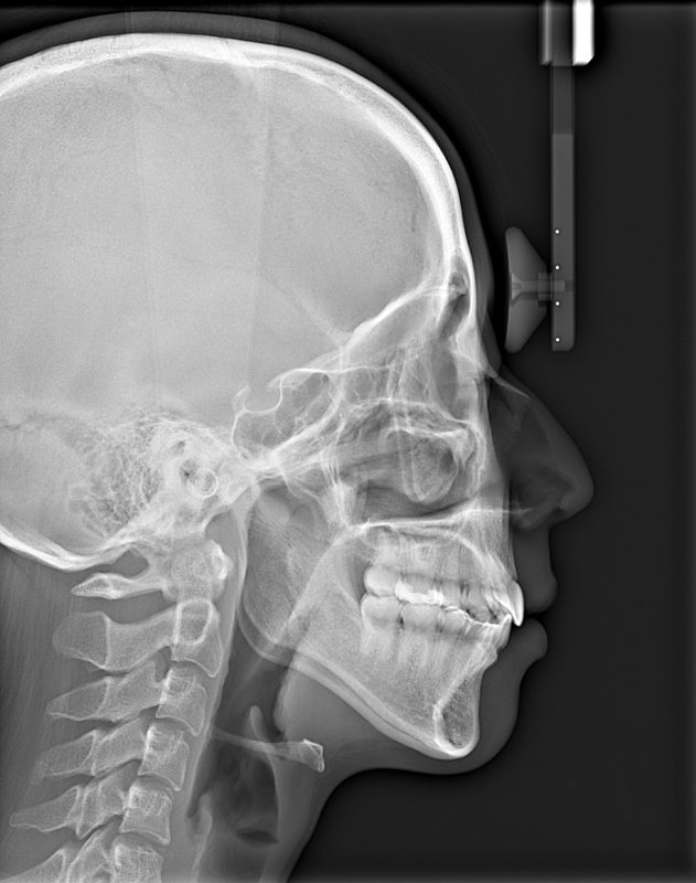 側方セファロレントゲン