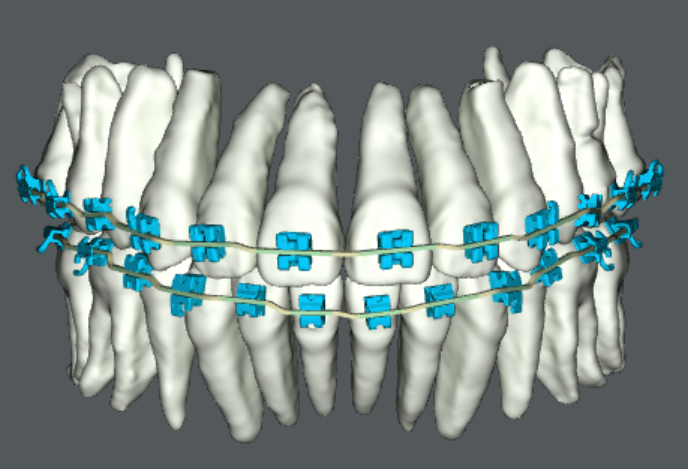 シュアスマイルワイヤー