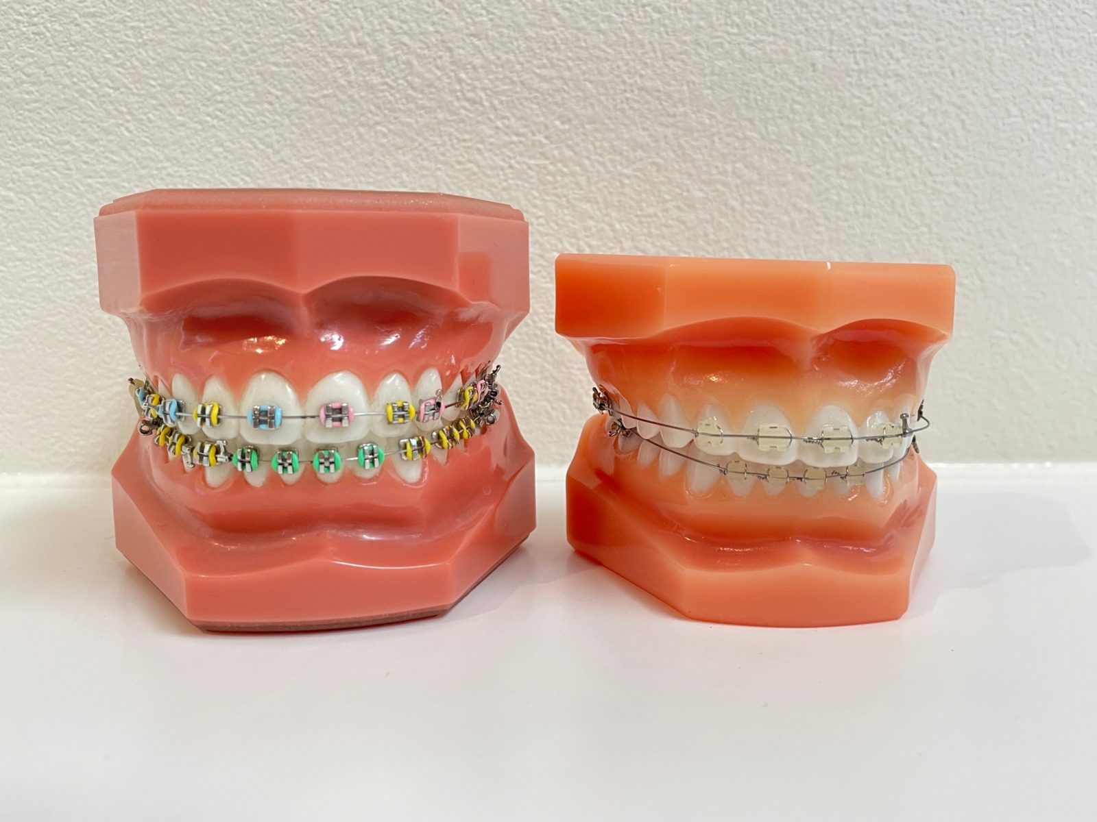 マルチブラケット装置/装置をつける5つの流れ | 旭川公園通り矯正歯科