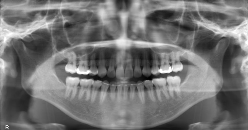 パノラマレントゲン