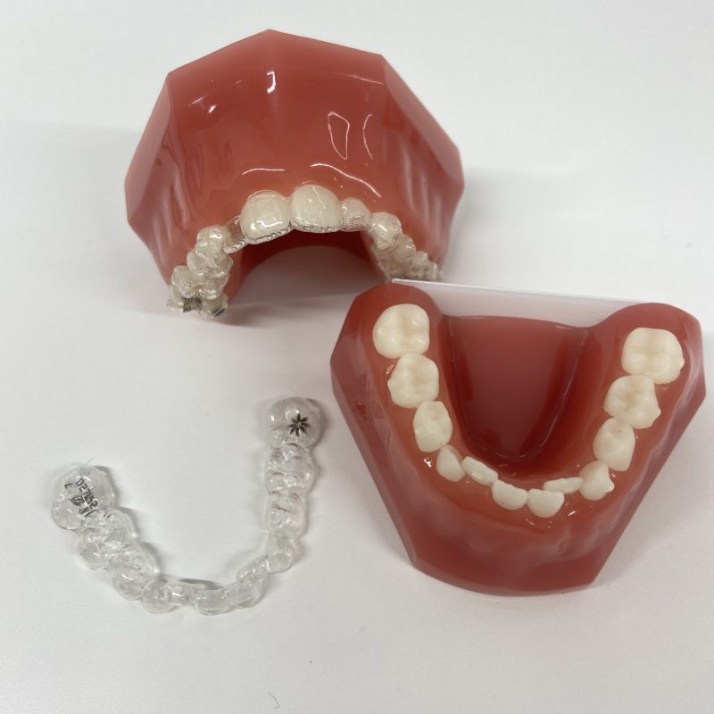 インビザライン・ファースト