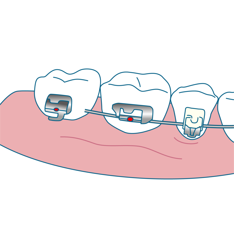 ワイヤーが外れている