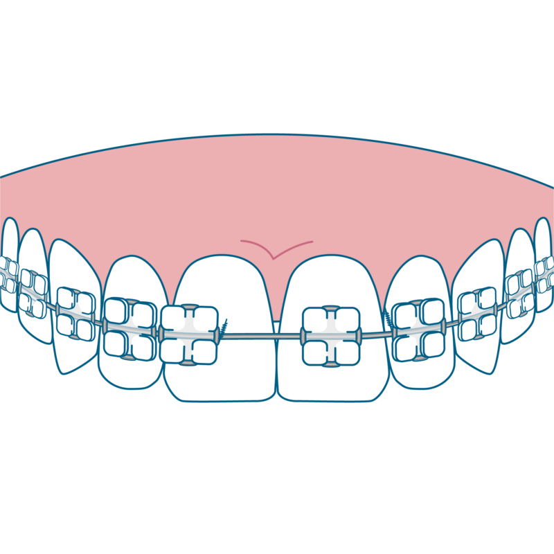ブラケットが外れている