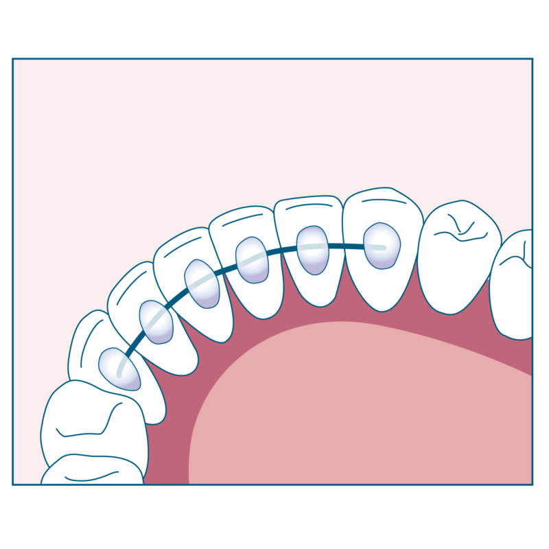 フィックスリテーナー