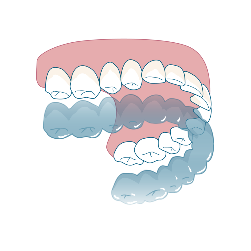 ソフトリテーナー