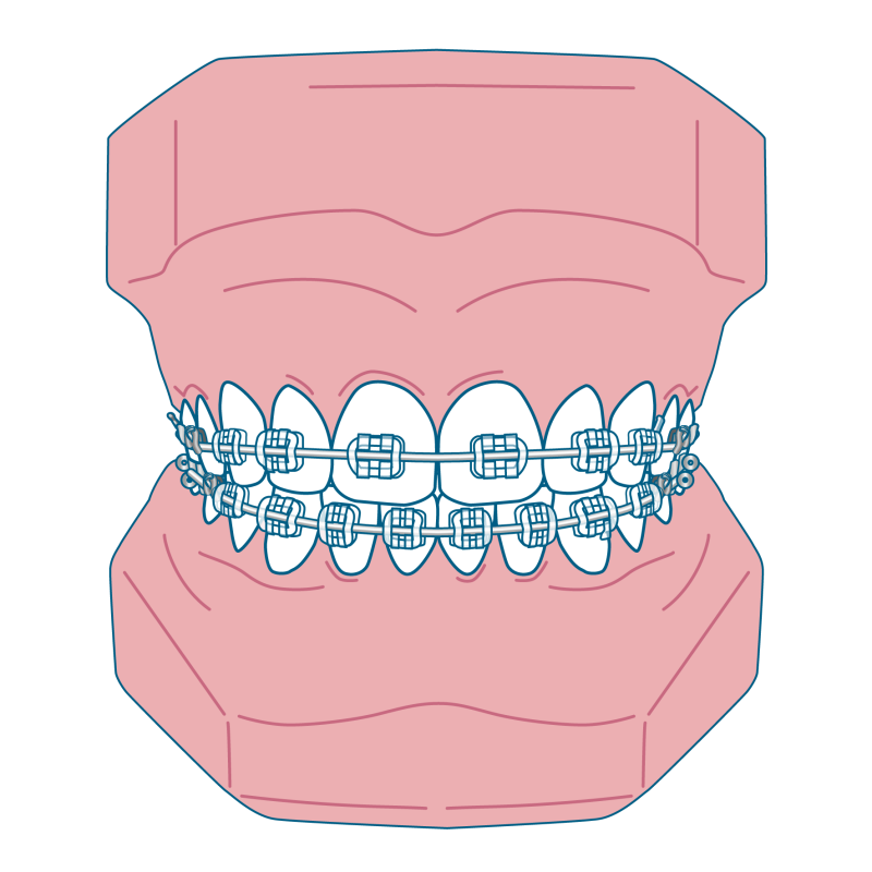 セラミックブラケット