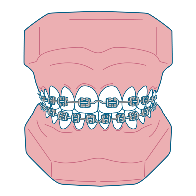 メタルブラケット