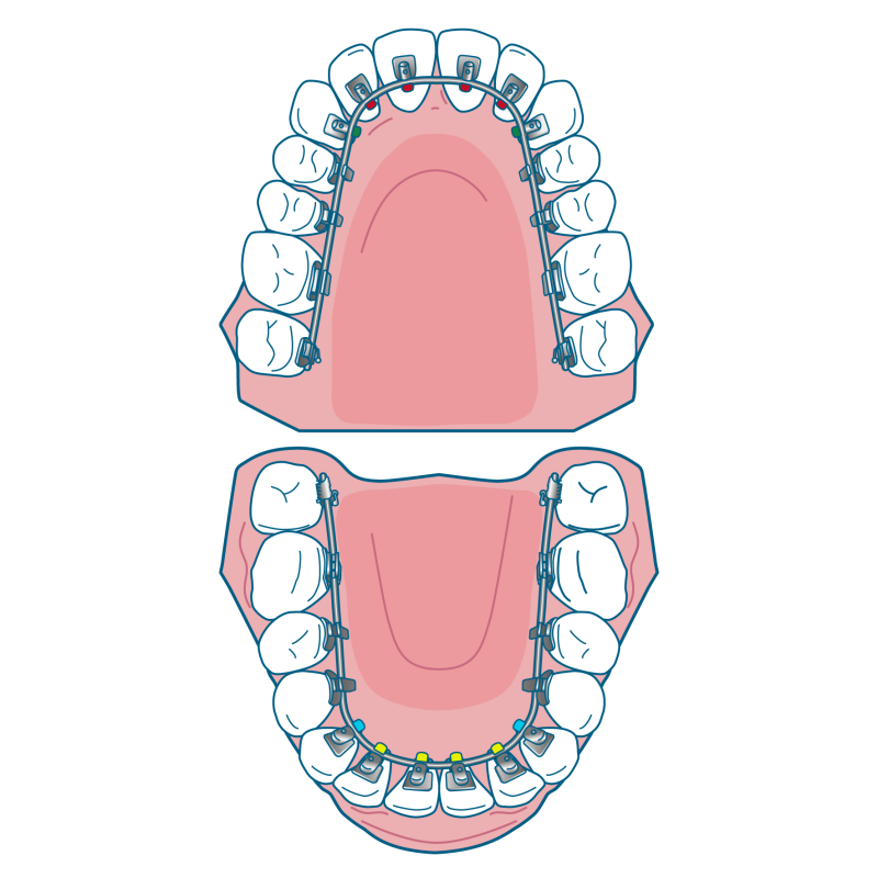 リンガルブラケット