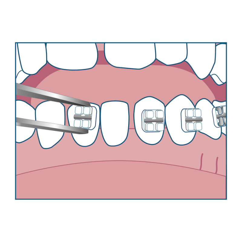 ブラケット装着