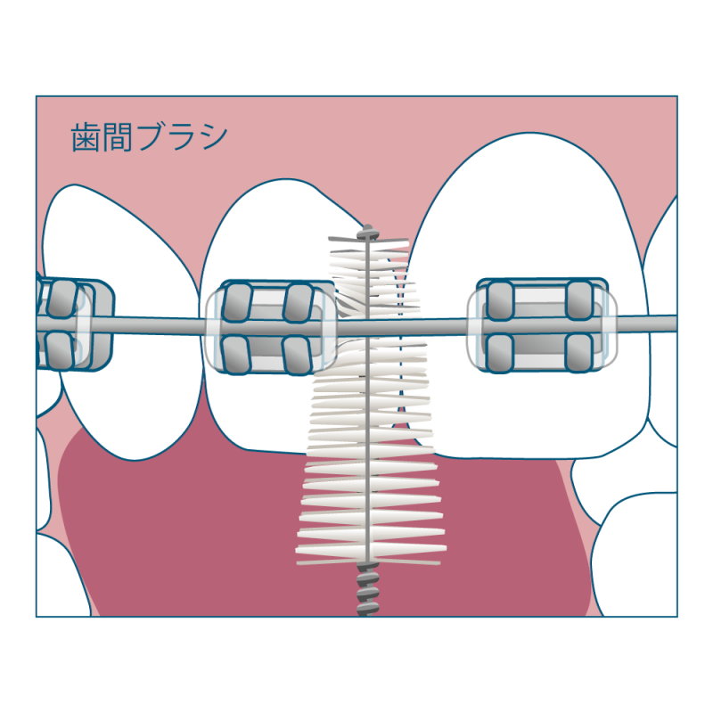 歯間ブラシ