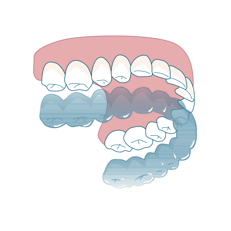 マウスピース矯正