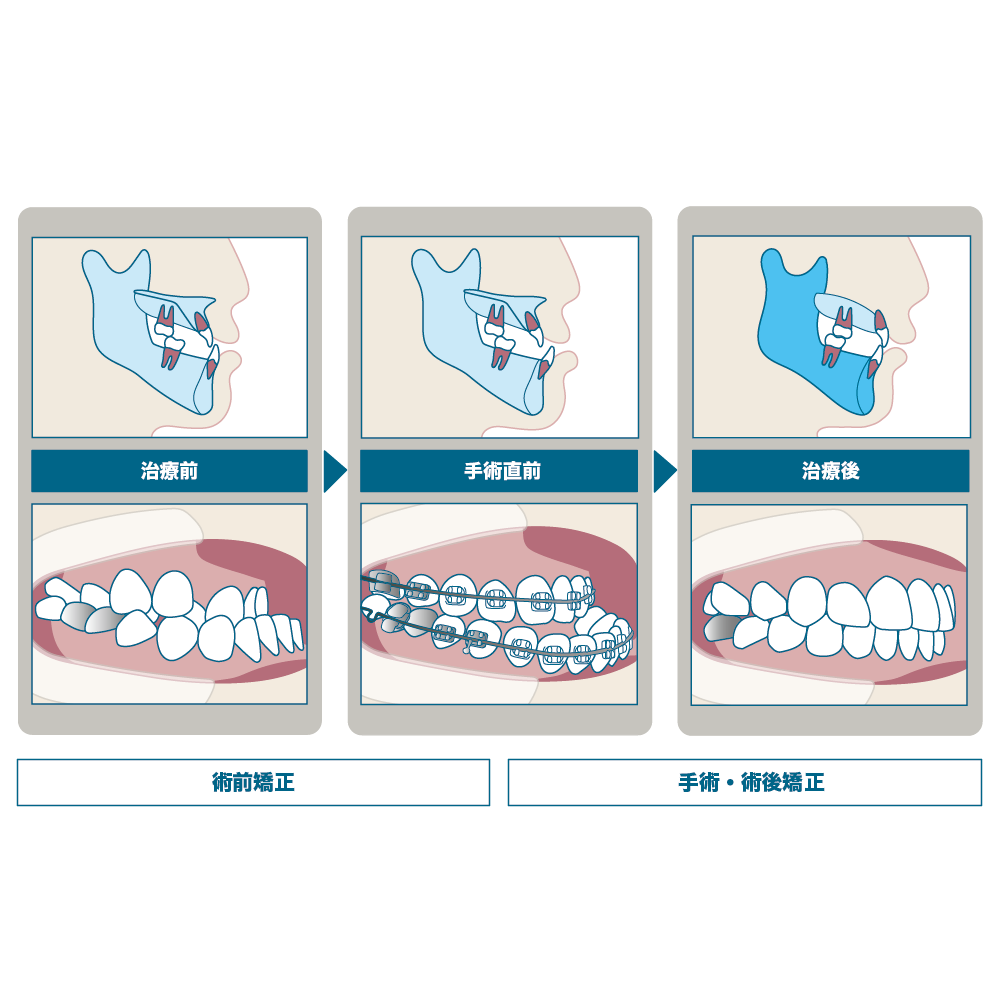外科的矯正治療