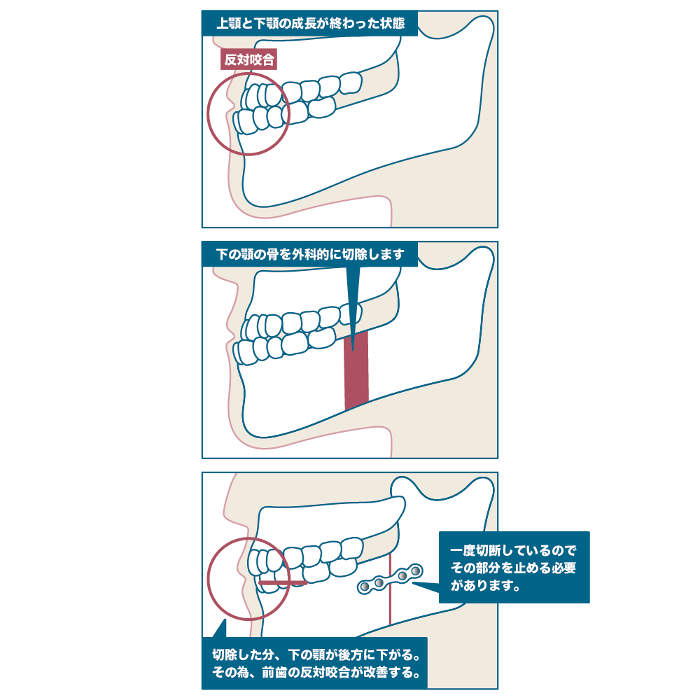 顎矯正手術