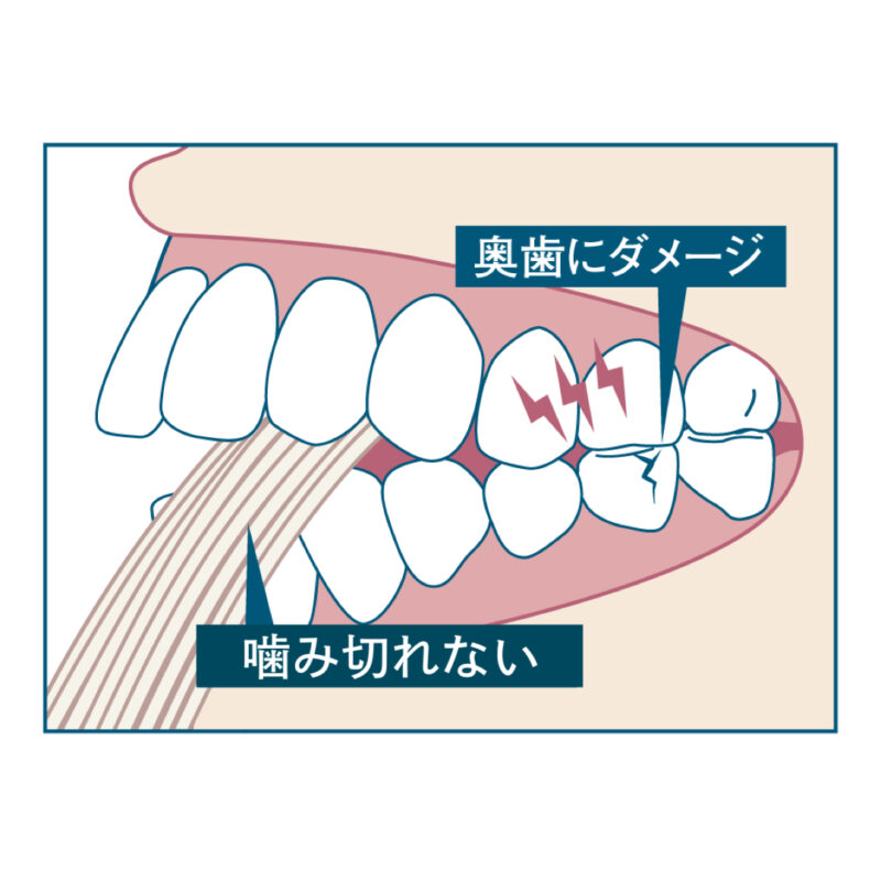 開咬